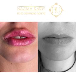 תמונות לפני ואחרי עיבוי שפתיים