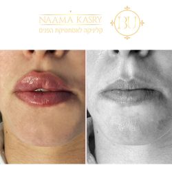 עיבוי שפתיים חומצה היאלורונית תמונות לפני ואחרי