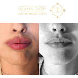 עיבוי שפתיים חומצה היאלורונית תמונות לפני ואחרי